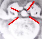 CT arachnoiditis