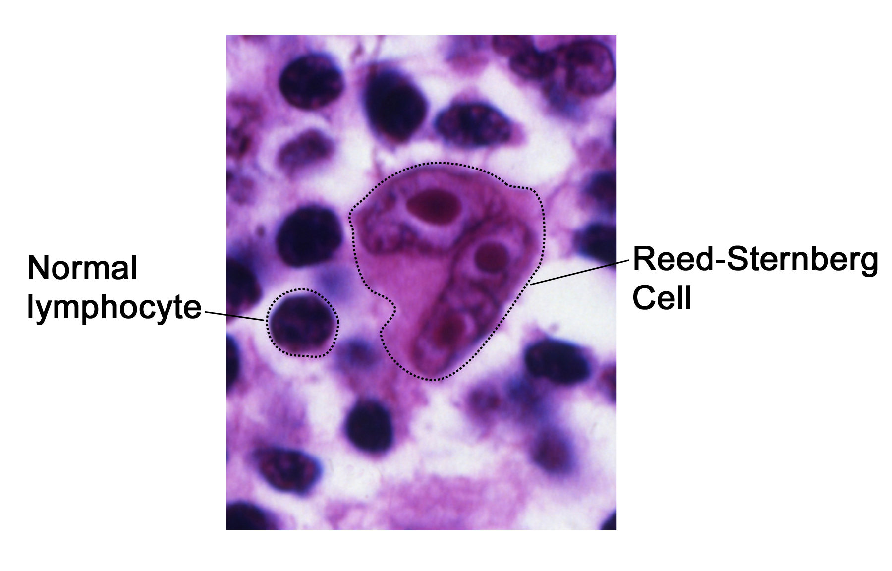 Reed-Sternberg cell