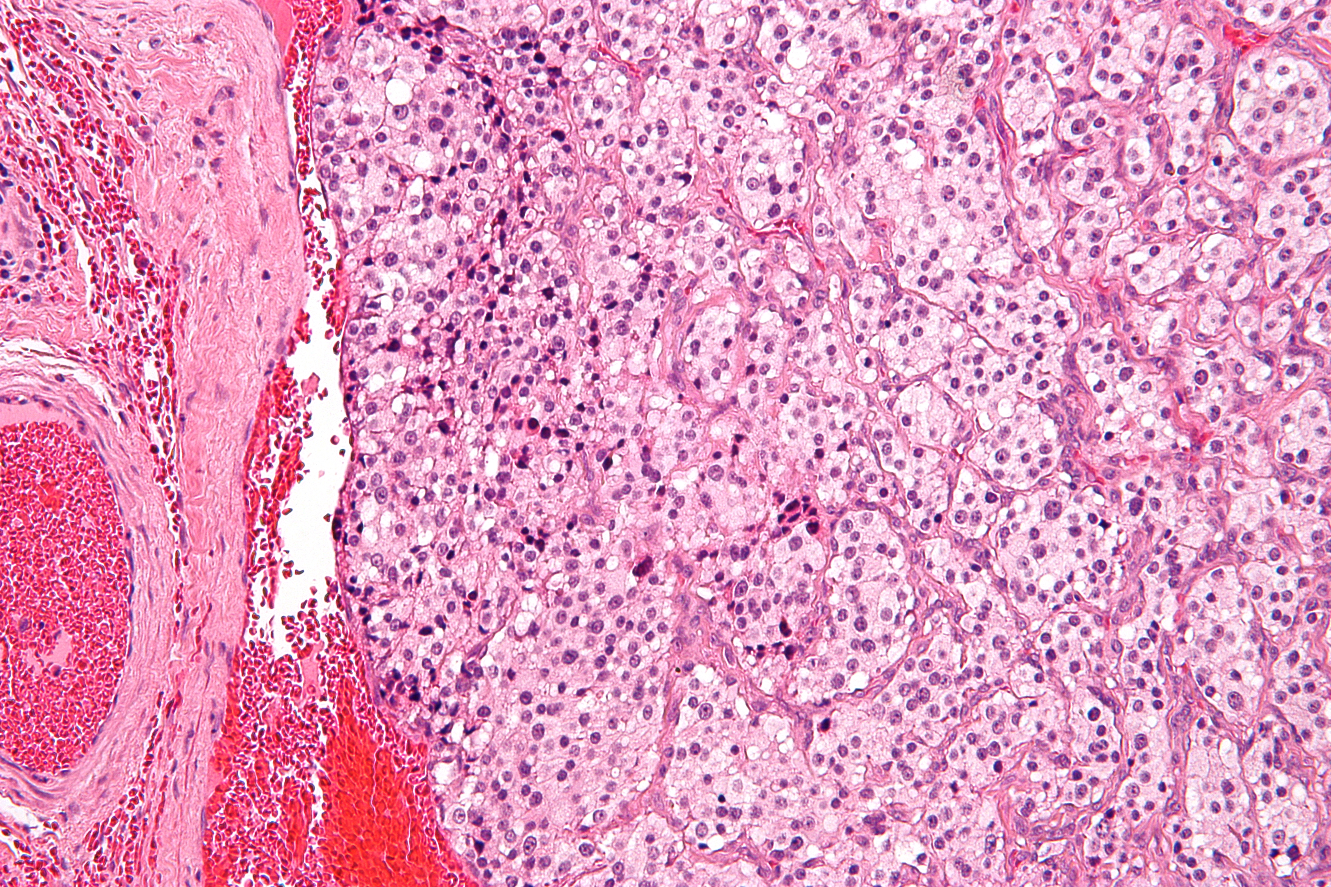Micrograph of a paraganglioma
