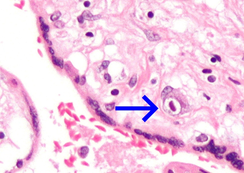 Micrograph of CMV placentitis