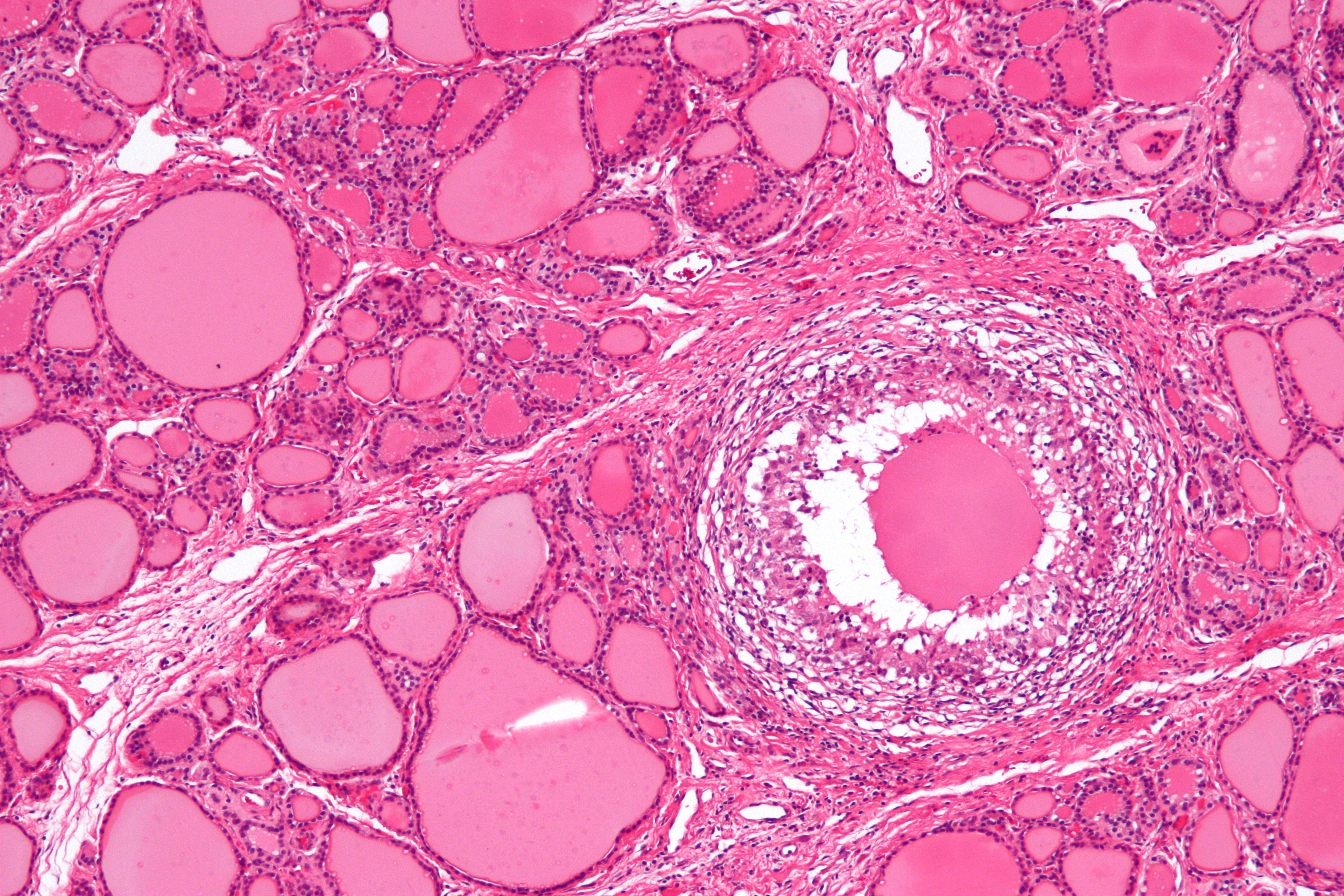 Micrograph of subacute thyroiditis