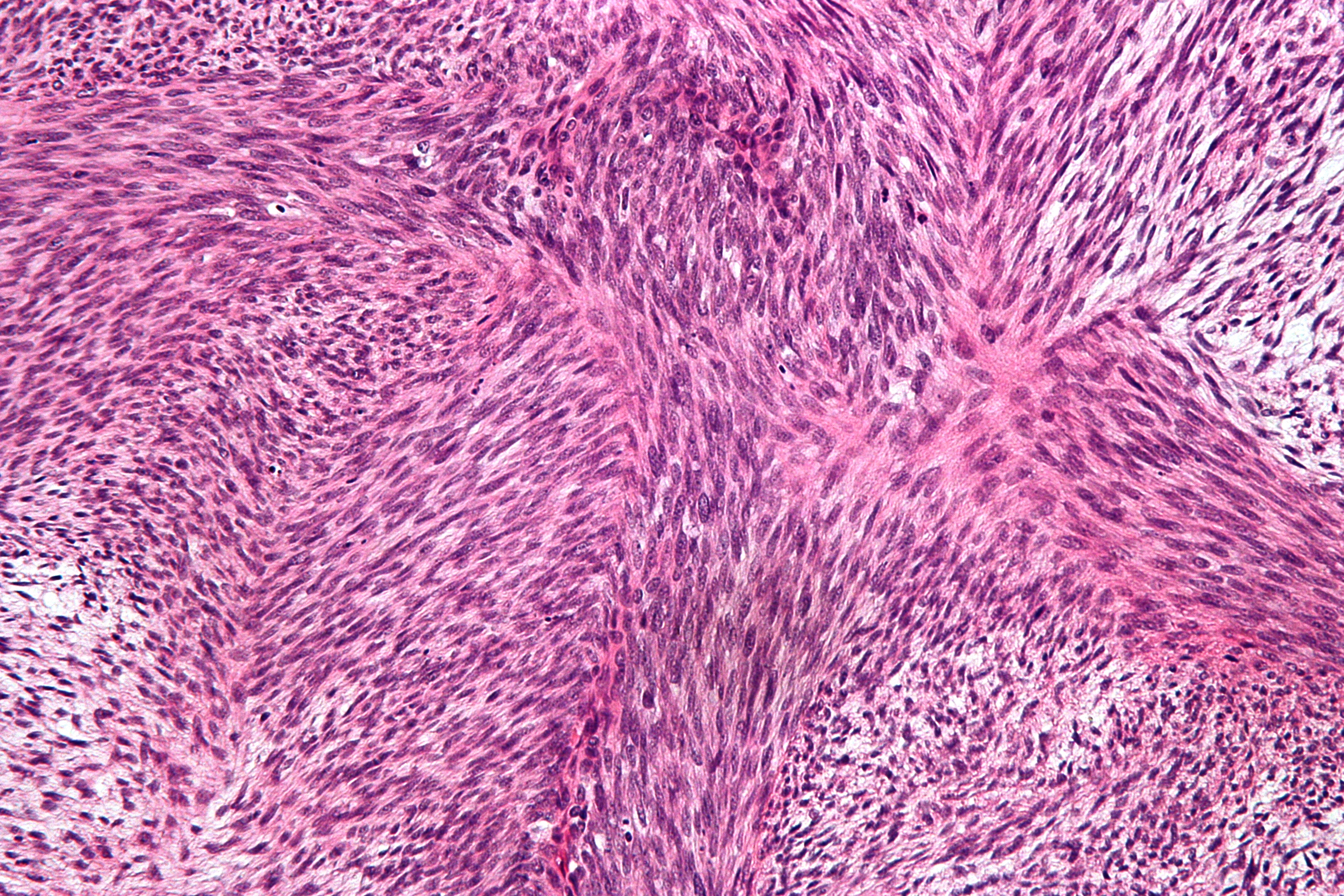 High magnification micrograph of a malignant peripheral nerve sheath tumor