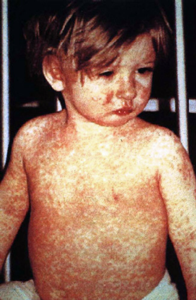 Measles rash