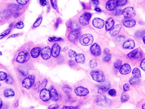 Micrograph of papillary thyroid carcinoma