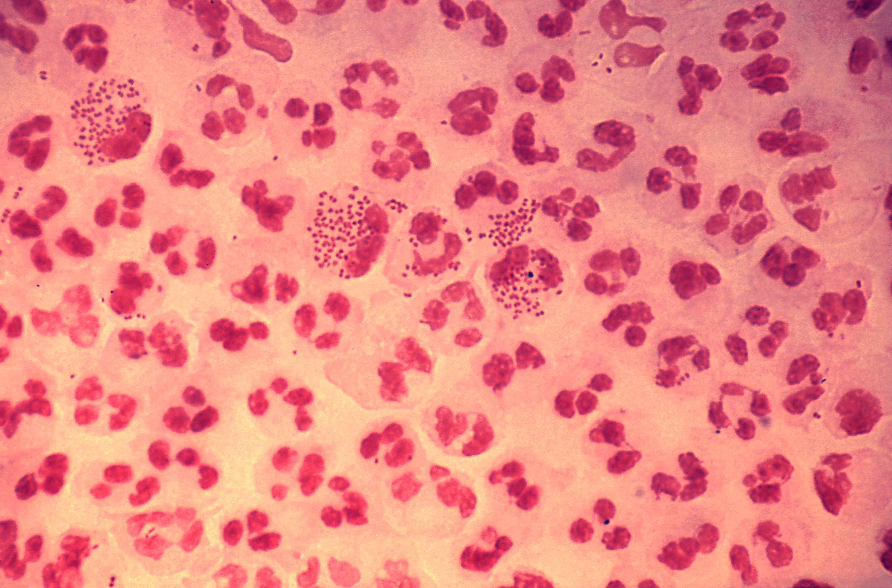 Micrograph of urethritis