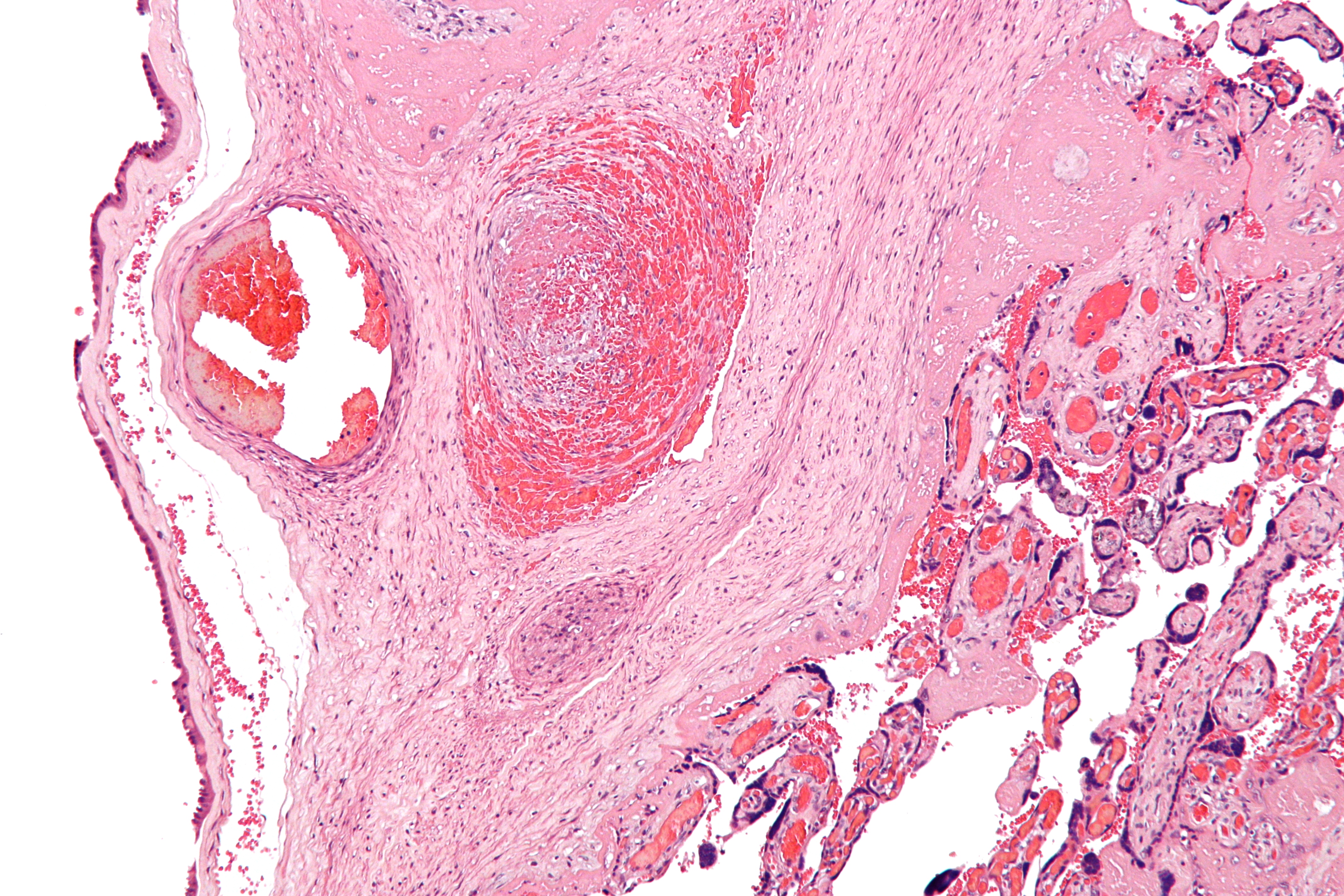 Micrograph of fetal thrombotic vasculopathy