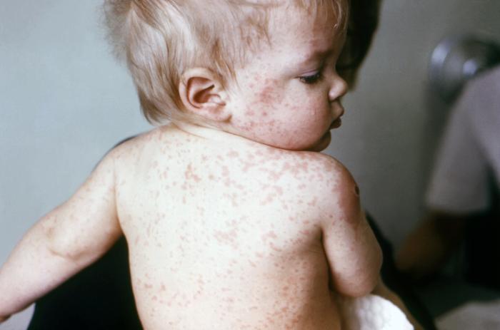 Young boy with measles