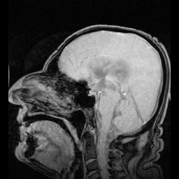 Superficial siderosis MRI