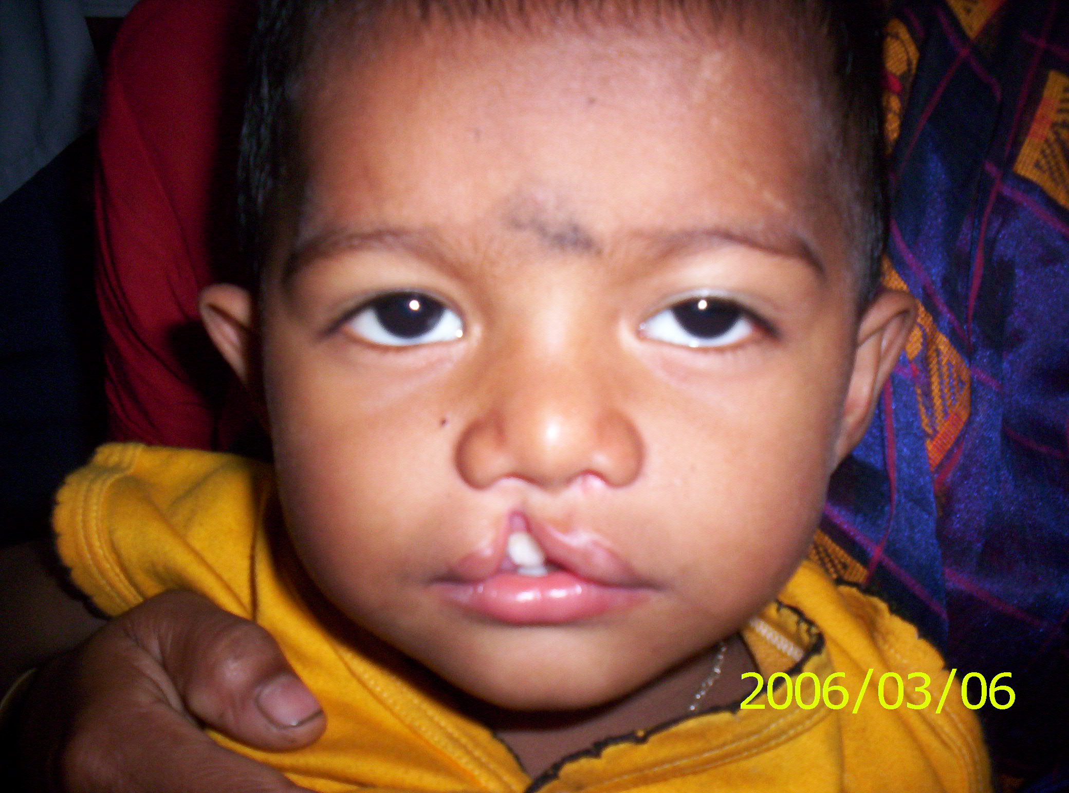 Child with cleft lip