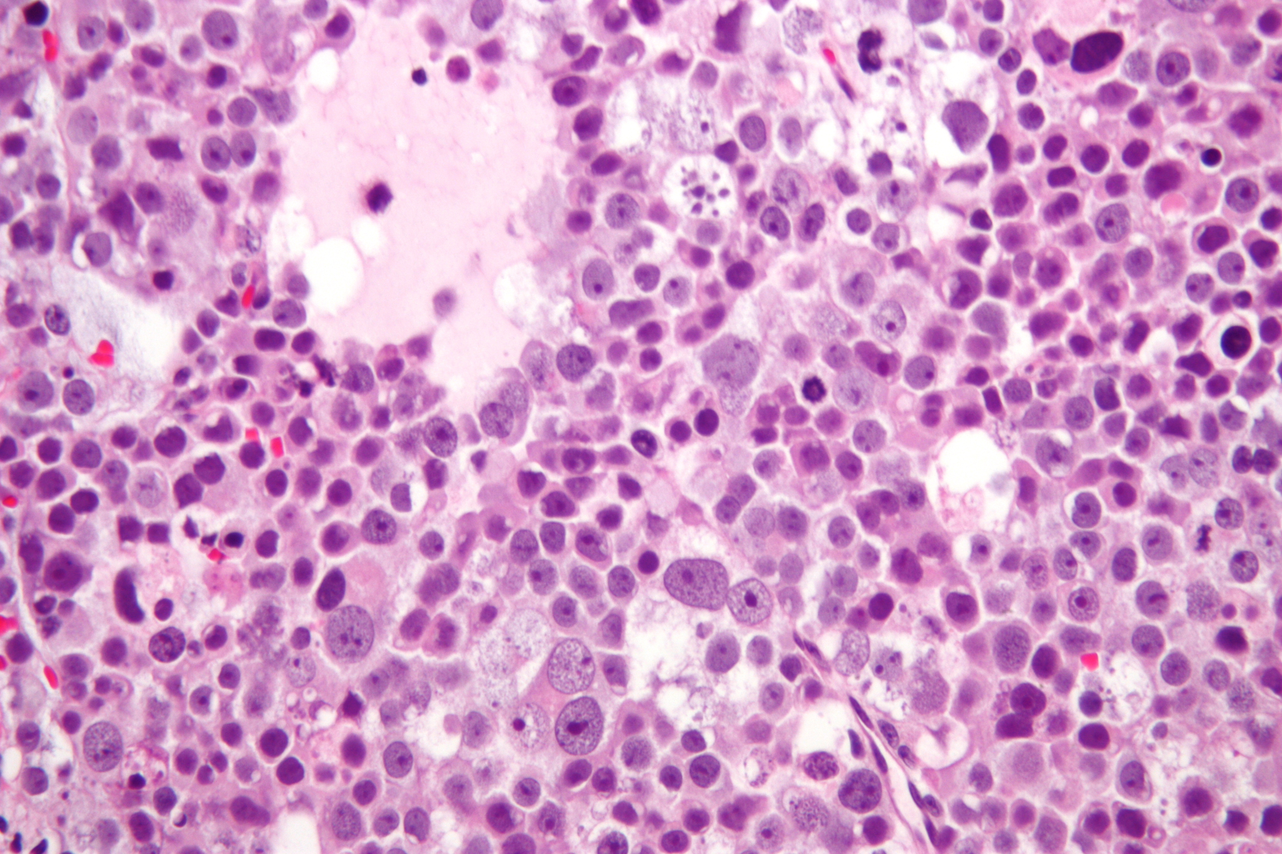 Micrograph of a spermatocytic tumor