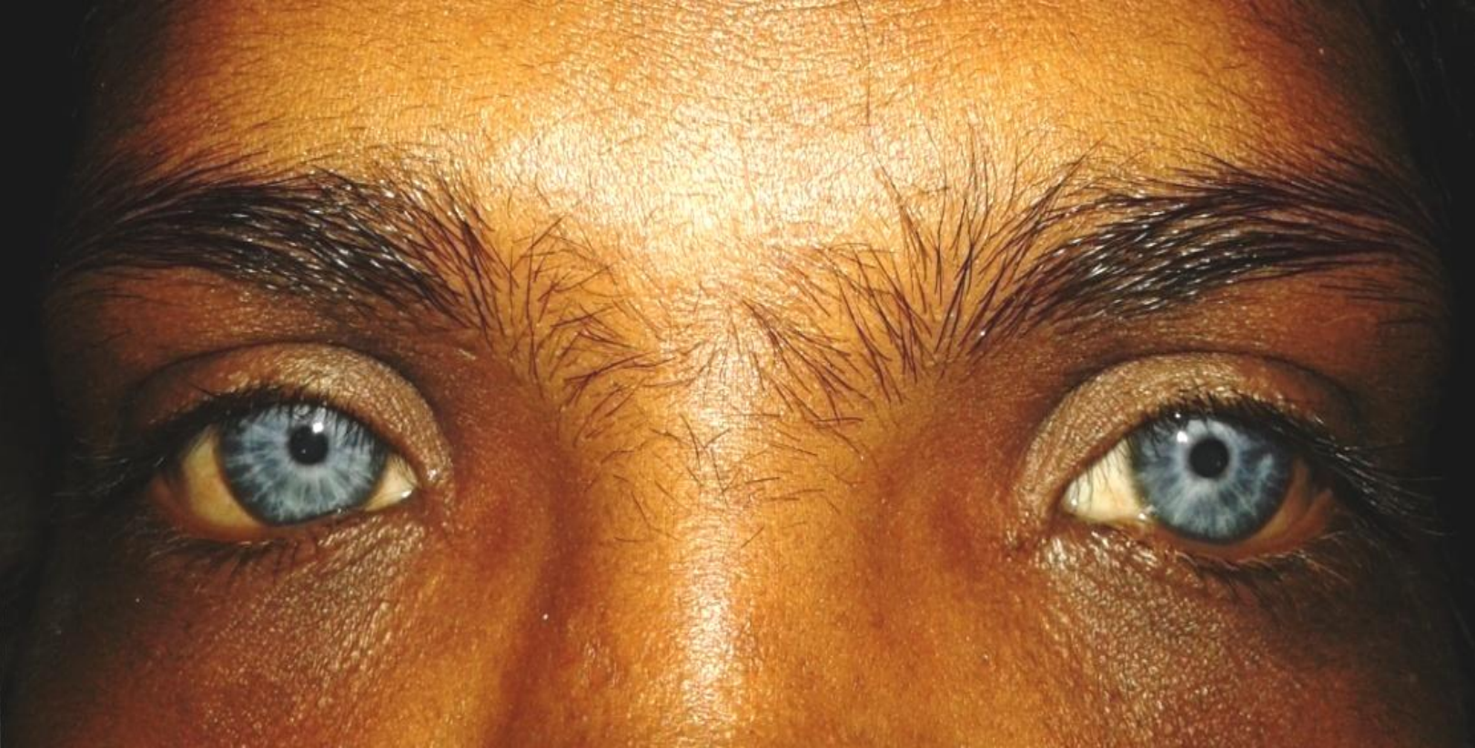 Image of Waardenburg syndrome type 1
