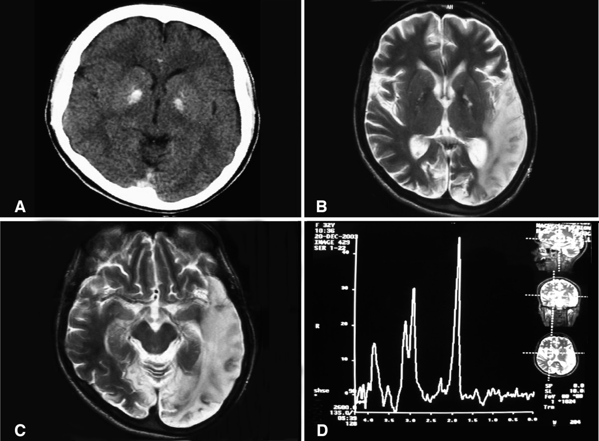 CT scan showing basal ganglia calcification