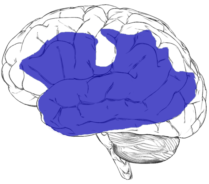 Diagram showing areas of the brain affected by aphasia