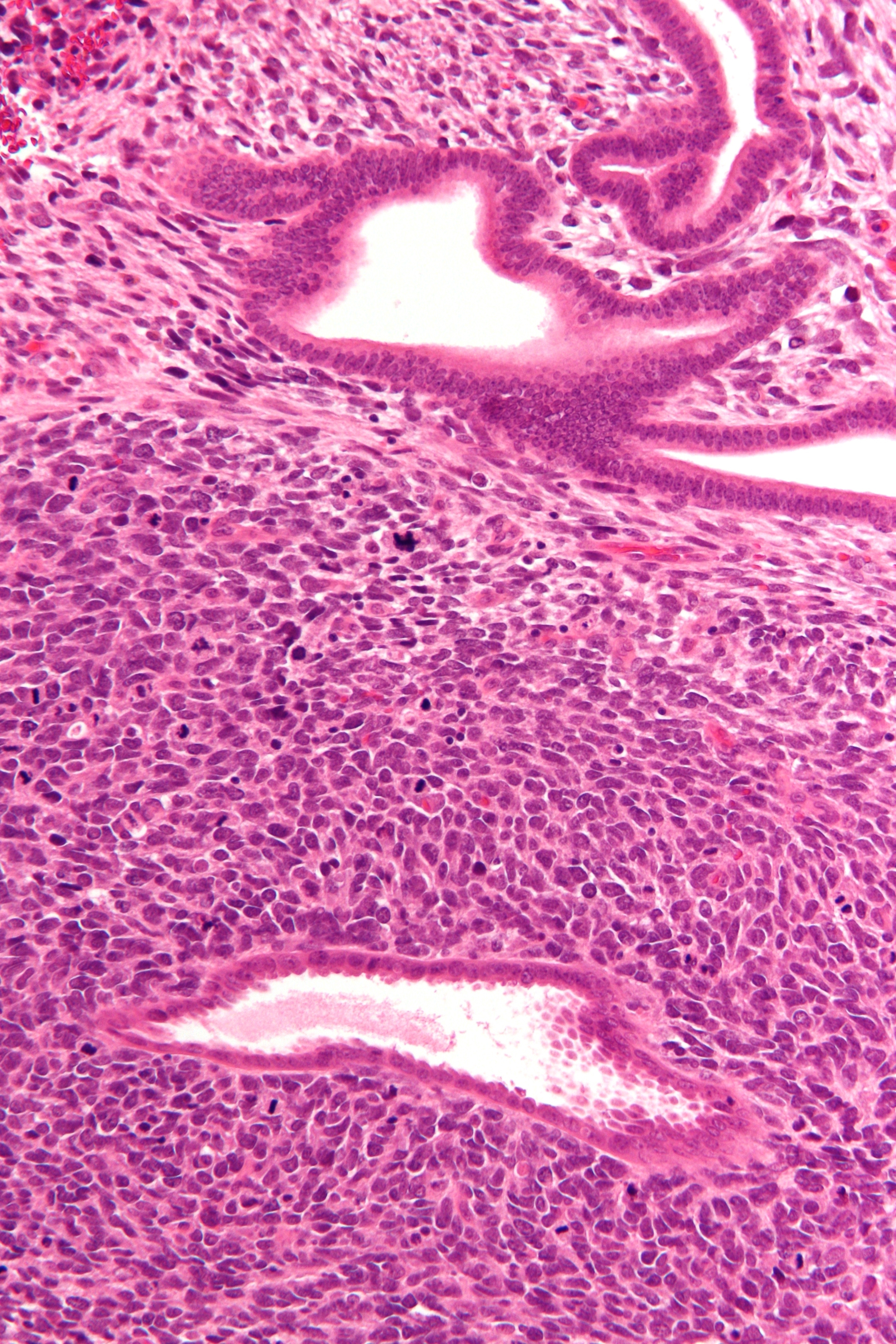 Micrograph of uterine adenosarcoma