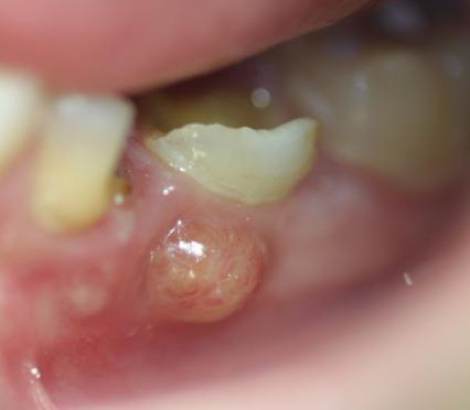Image of a dental abscess