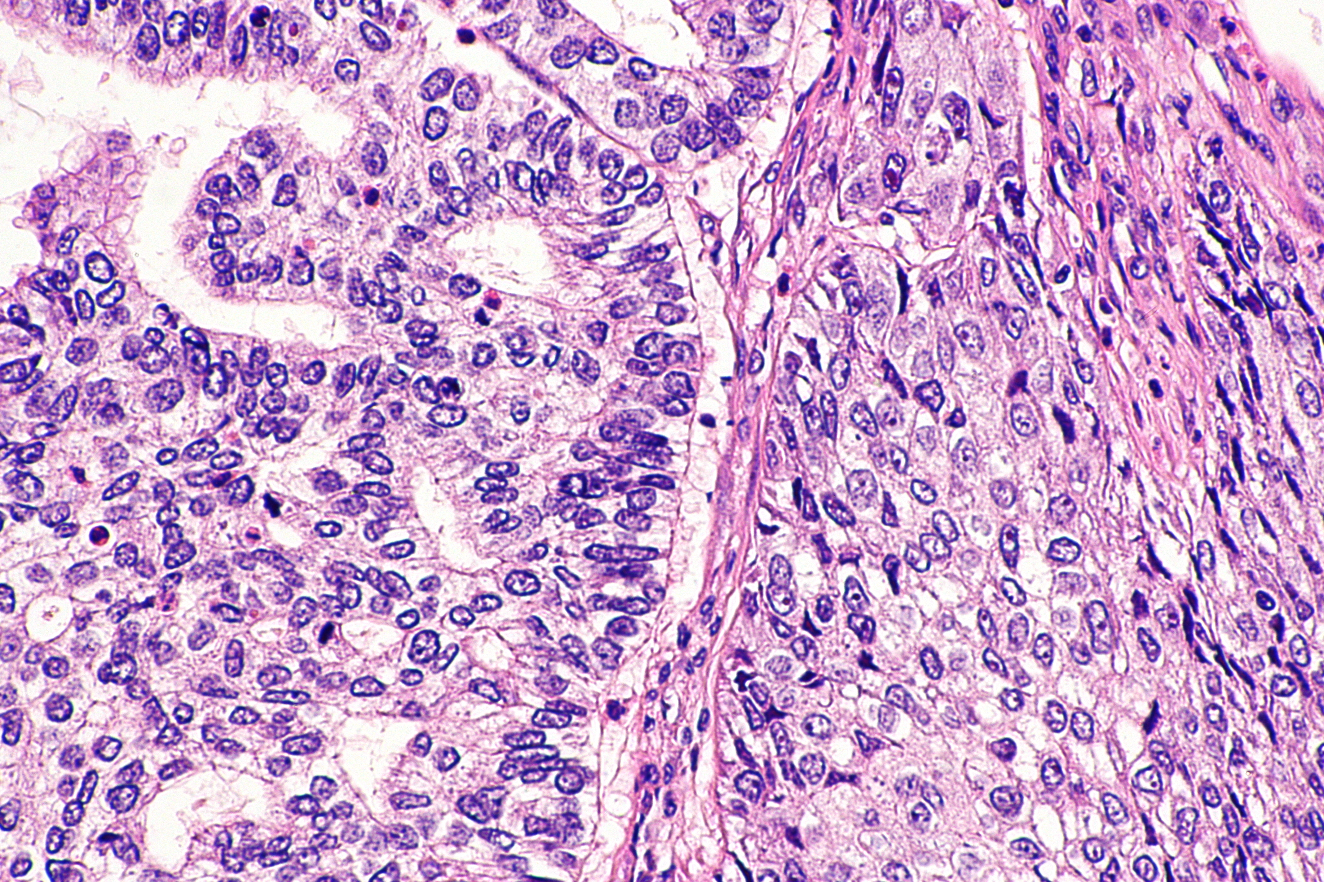Adenosquamous carcinoma of lung -- high mag