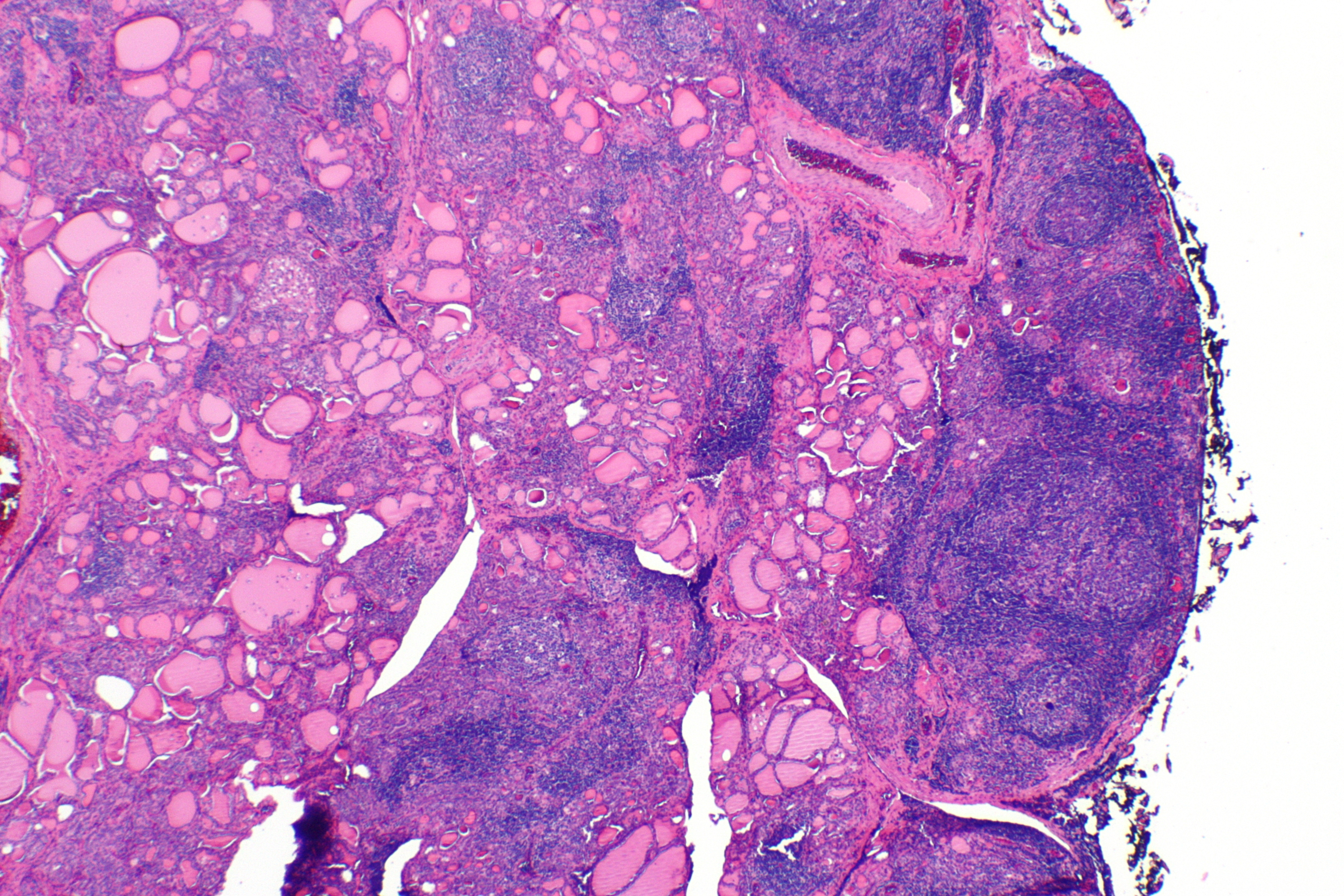 Micrograph of Hashimoto's thyroiditis