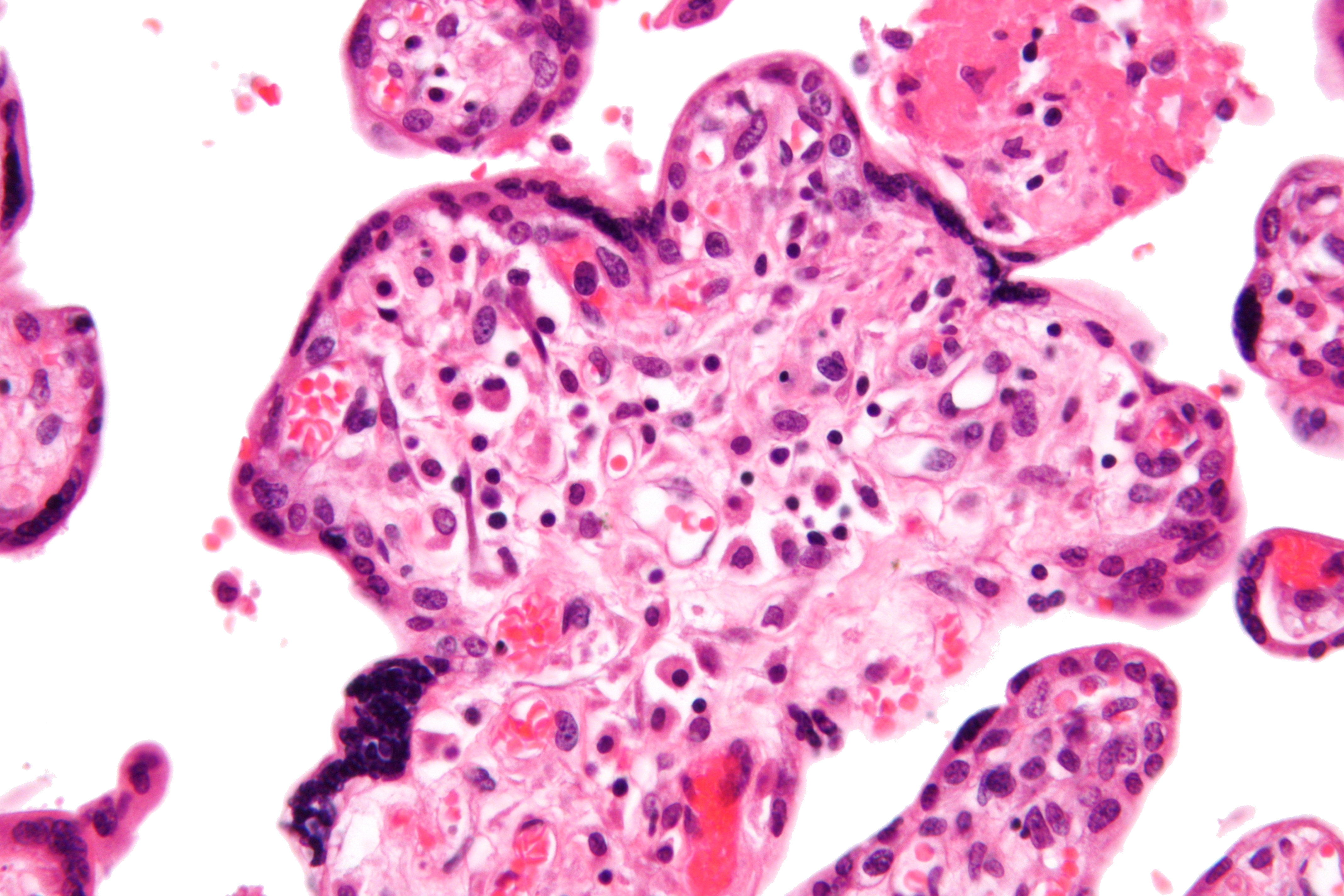 Micrograph of villitis of unknown etiology, a cause of intrauterine growth restriction