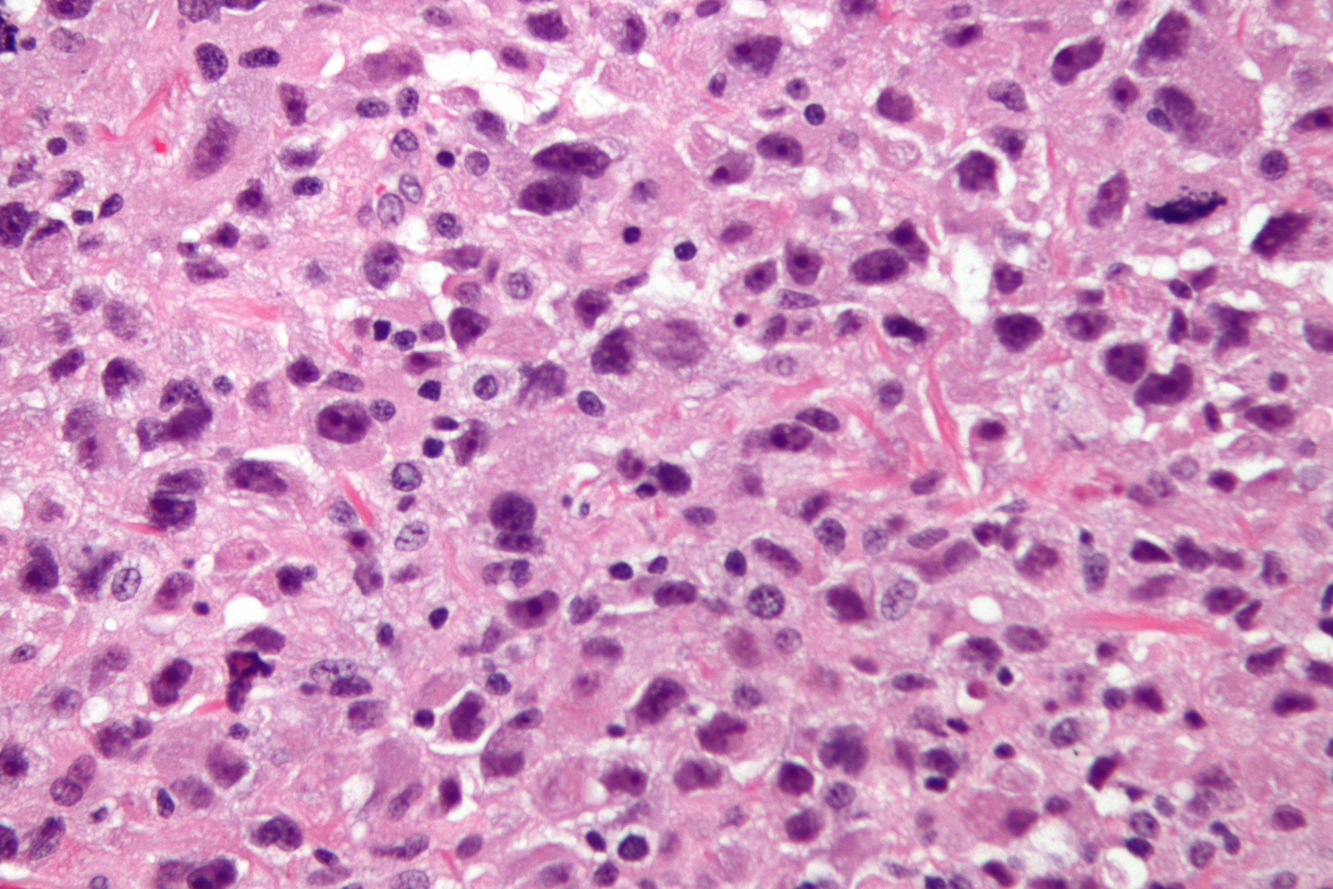 Micrograph of undifferentiated pleomorphic sarcoma