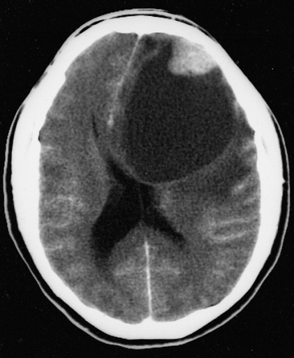 Histopathological image of pleomorphic xanthoastrocytoma