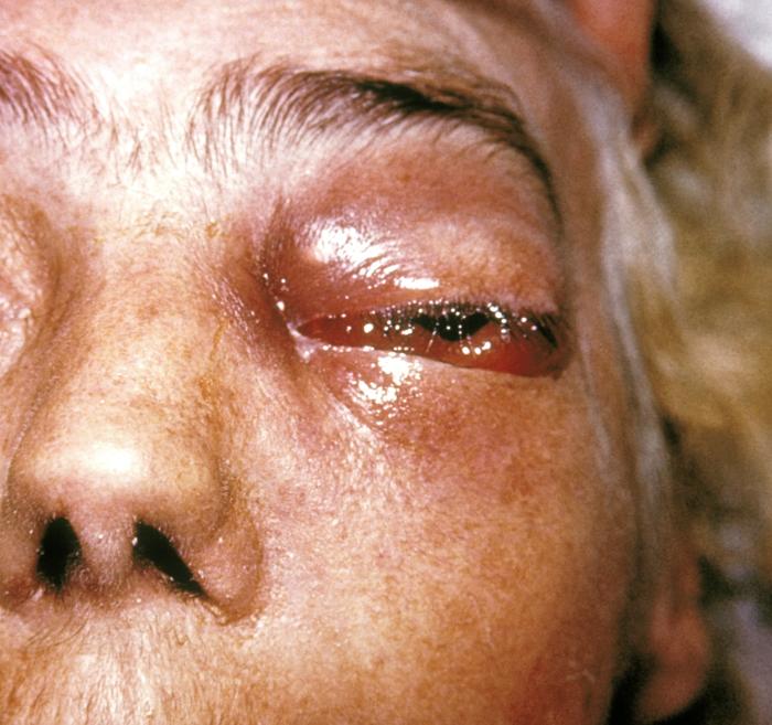 Zygomycosis