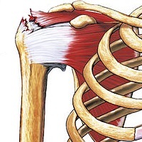 Rotator cuff tear