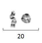 Ring chromosome 22