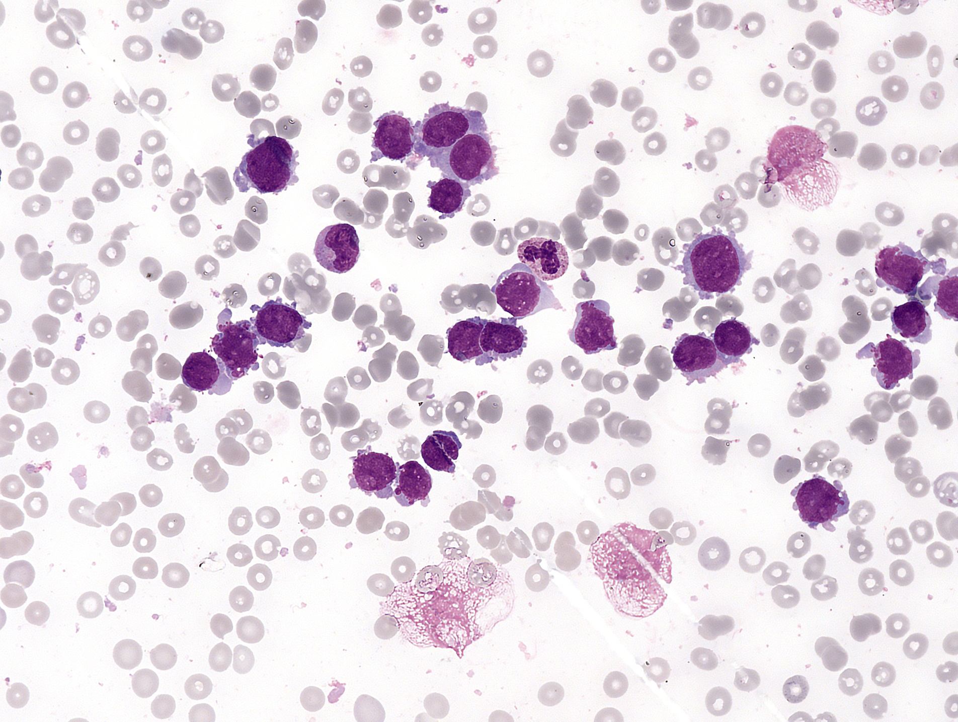 Micrograph of acute megakaryoblastic leukemia