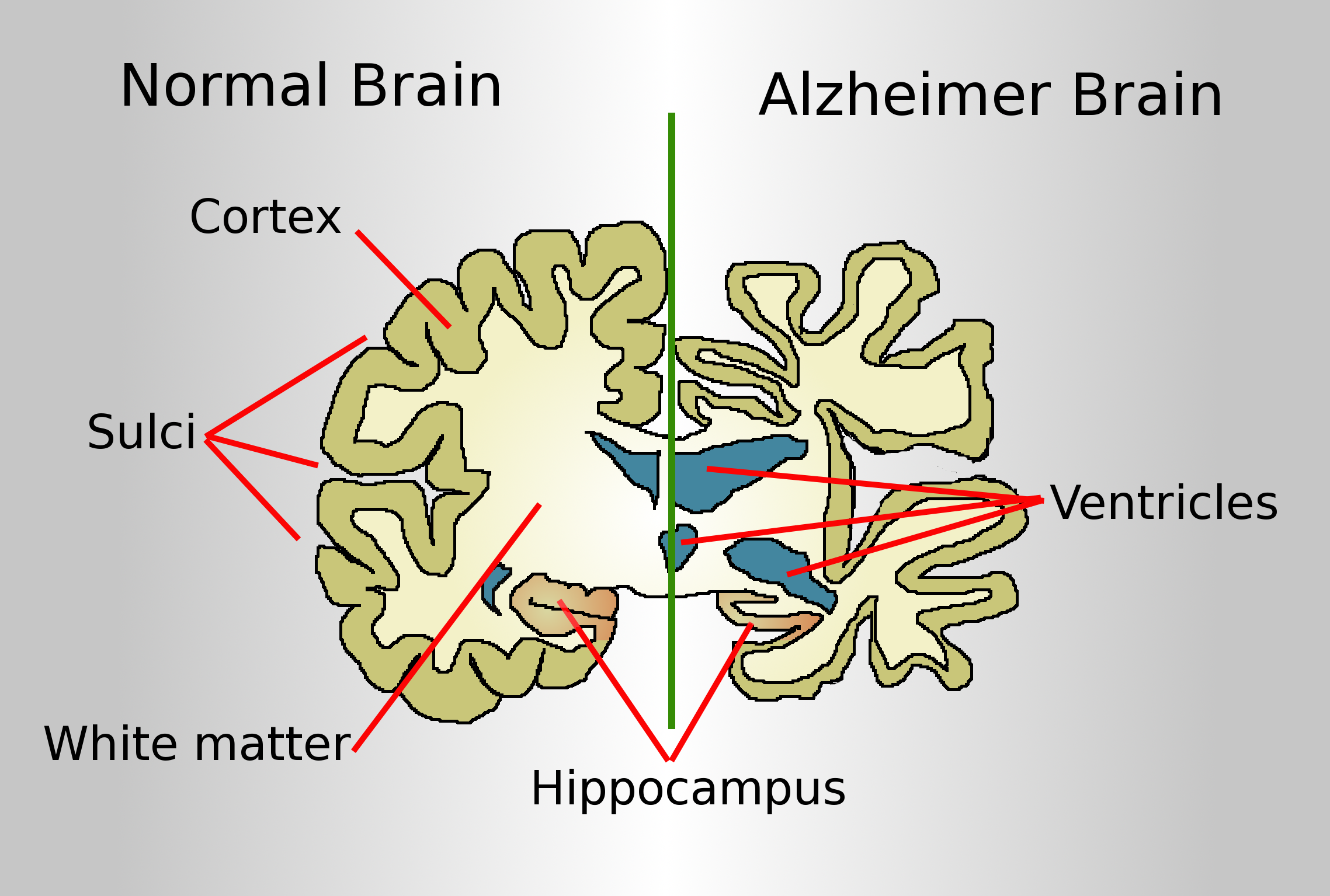 Diagram of the brain of a person with Alzheimer's disease