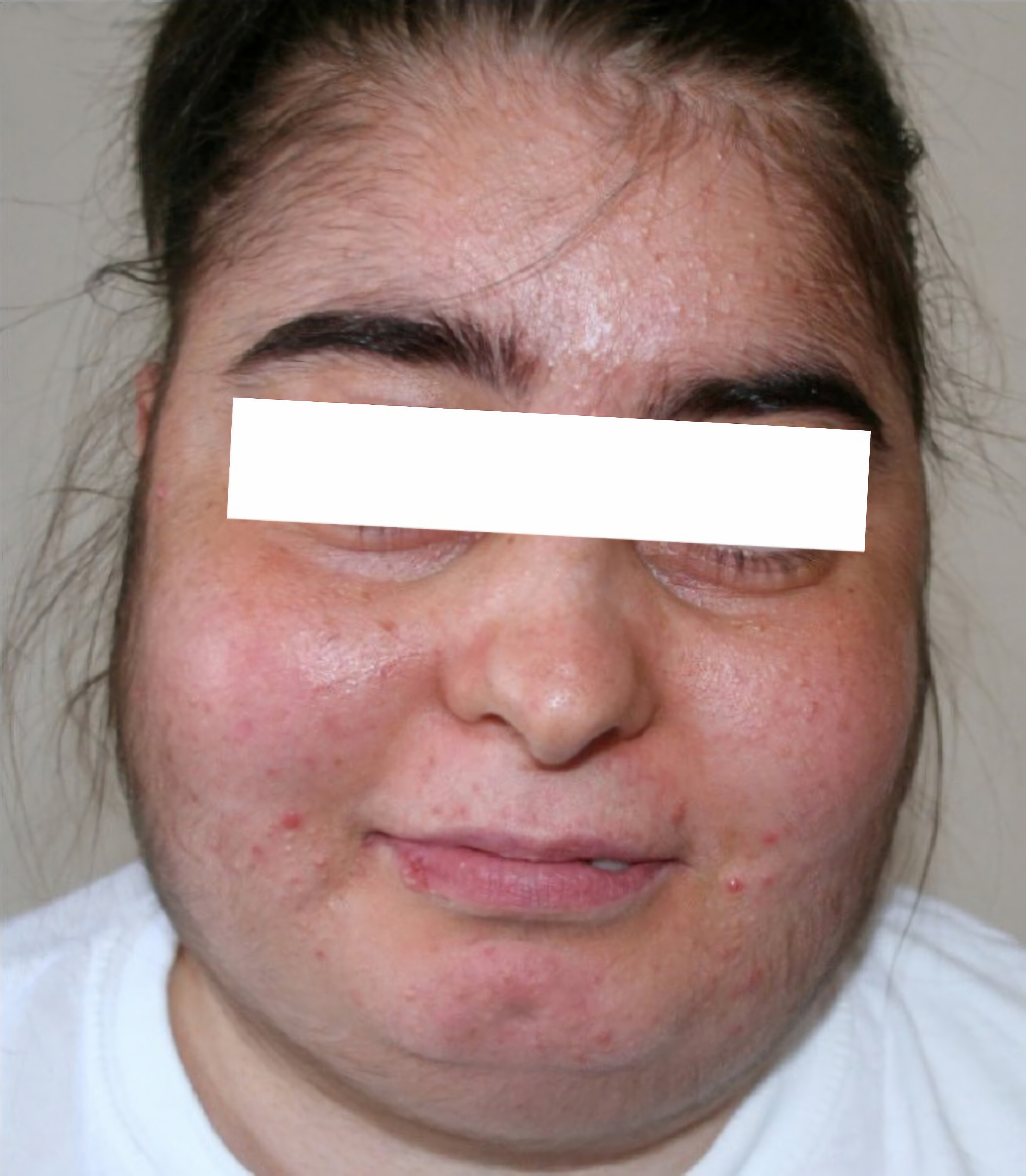 Moon face in Cushing's syndrome
