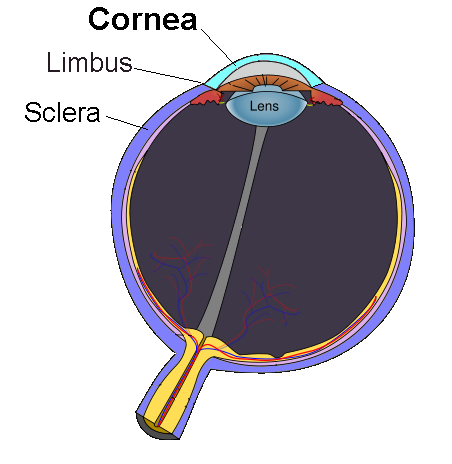 Corneal dystrophy