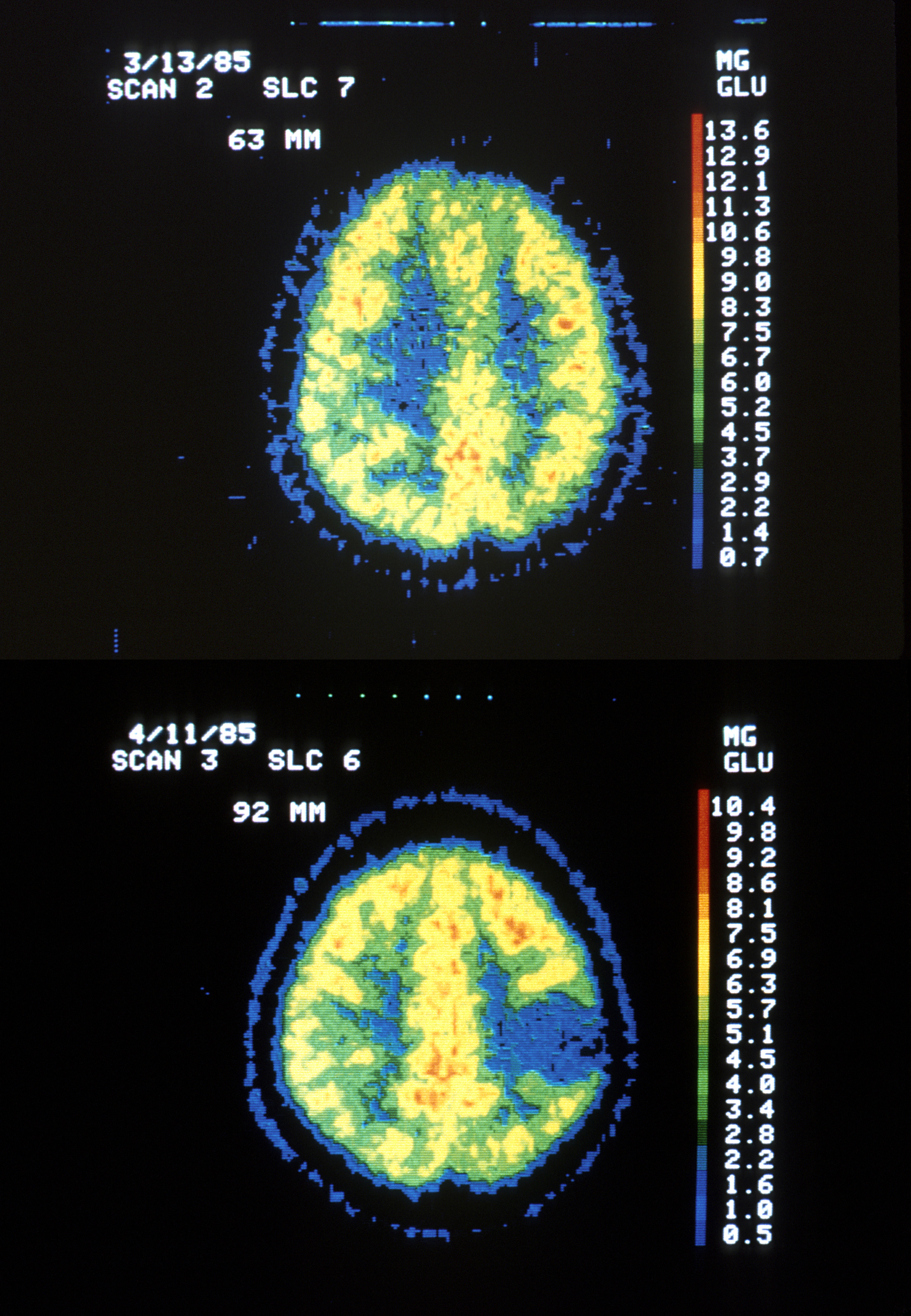 Astrocytoma