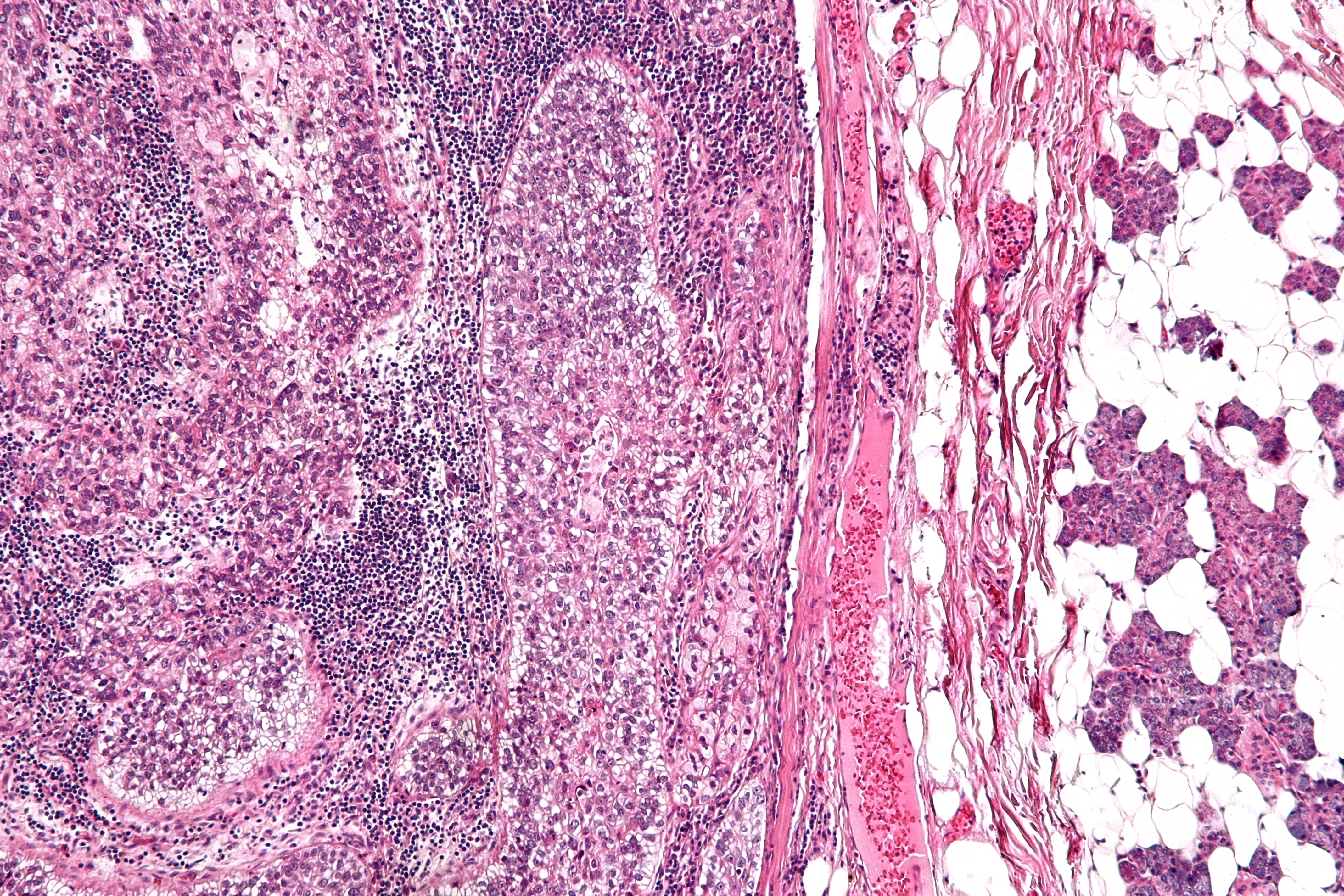 Micrograph of sebaceous carcinoma