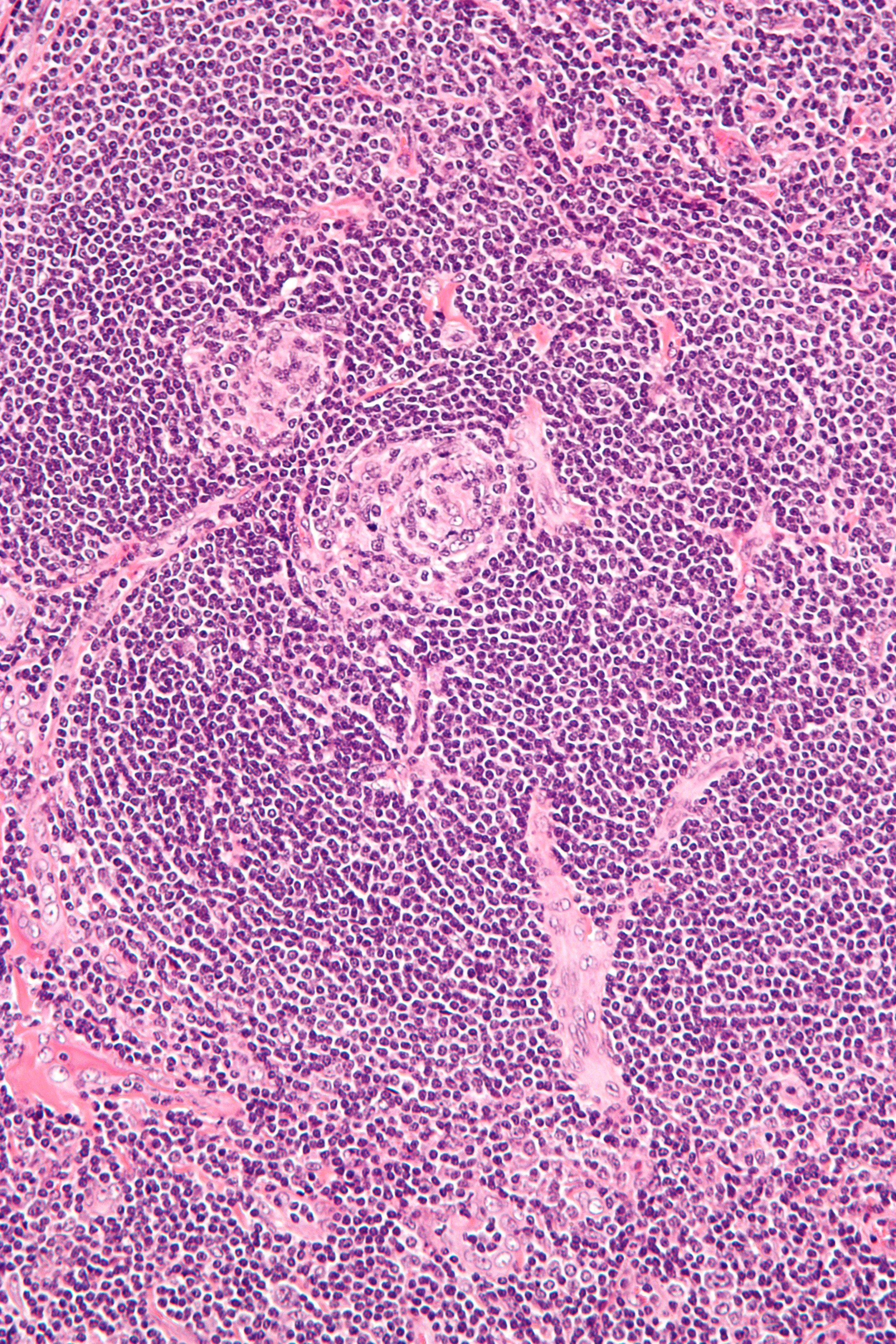 Micrograph of Castleman disease