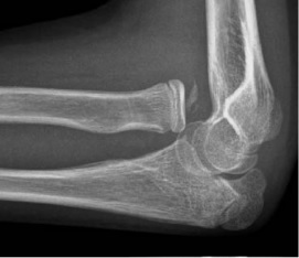 X-ray of ventral dislocation of the radial head. There is calcification of annular ligament, which can be seen as early as 2 weeks after injury.[1]