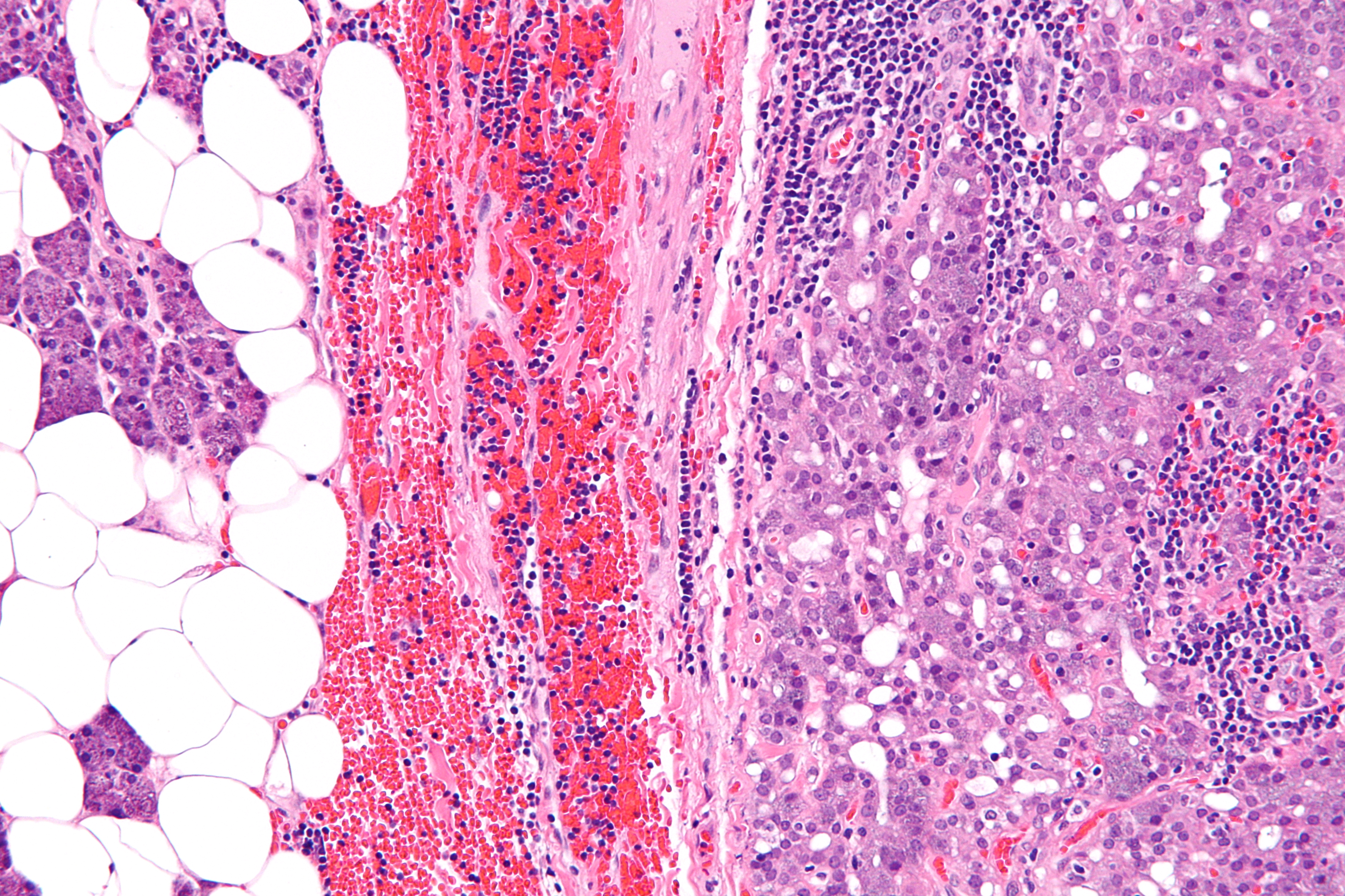 Micrograph of acinic cell carcinoma