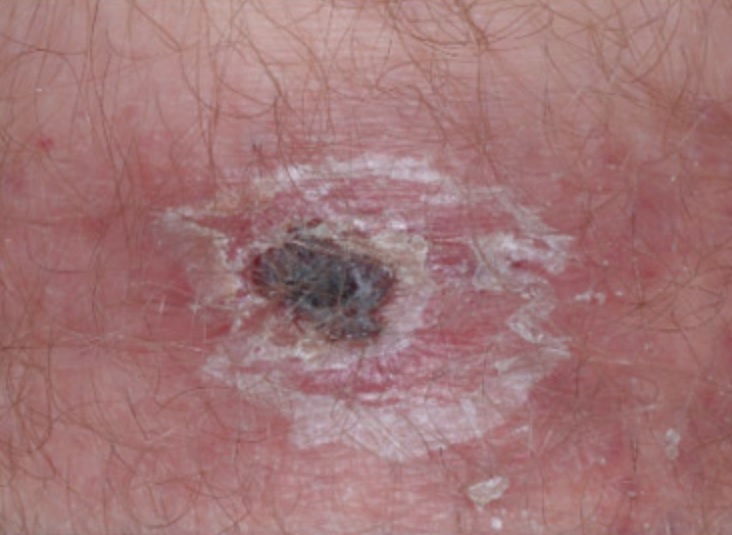 Eschar from tick bite