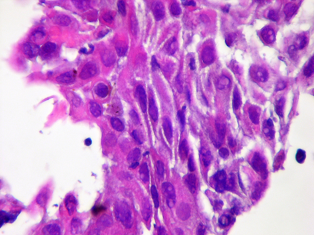 Micrograph of squamous-cell carcinoma of the thyroid