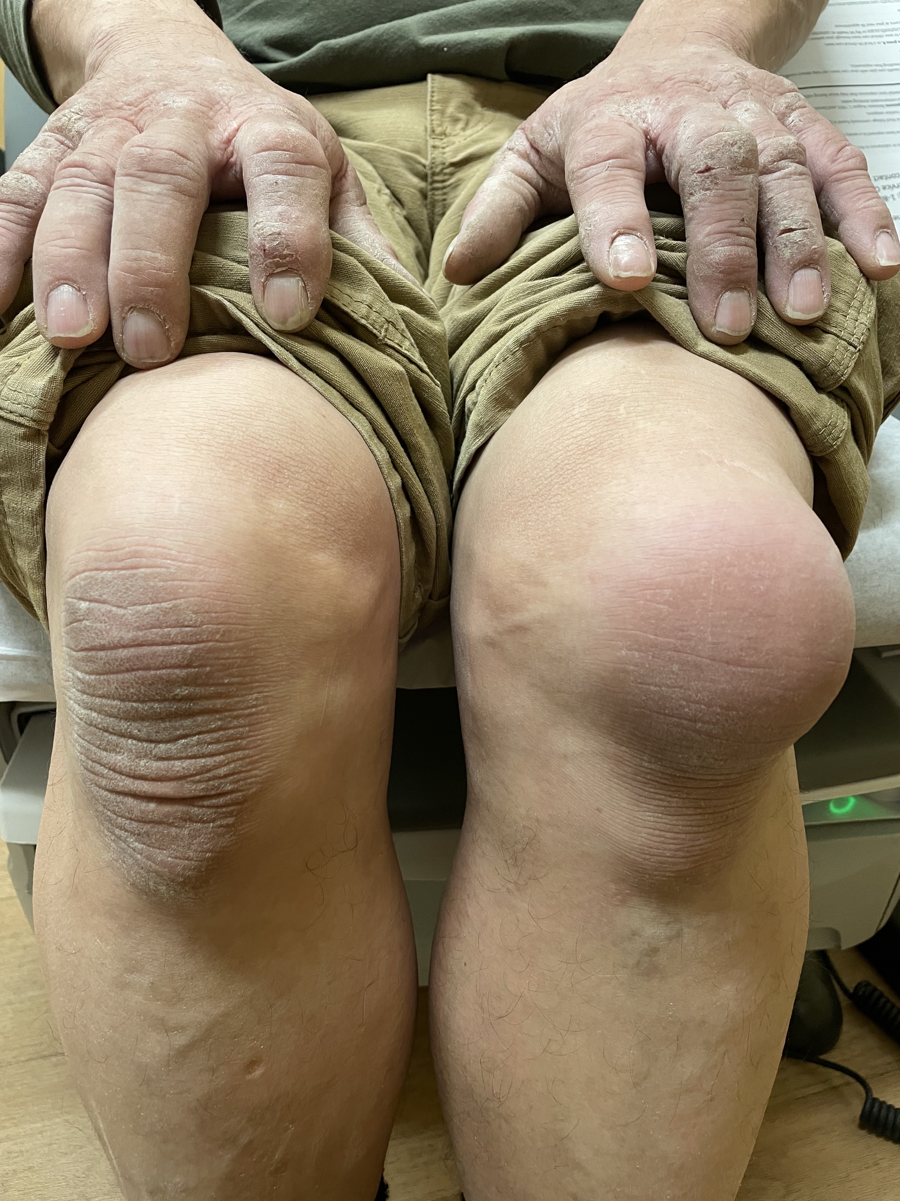 thumb knee prepatellar bursitis