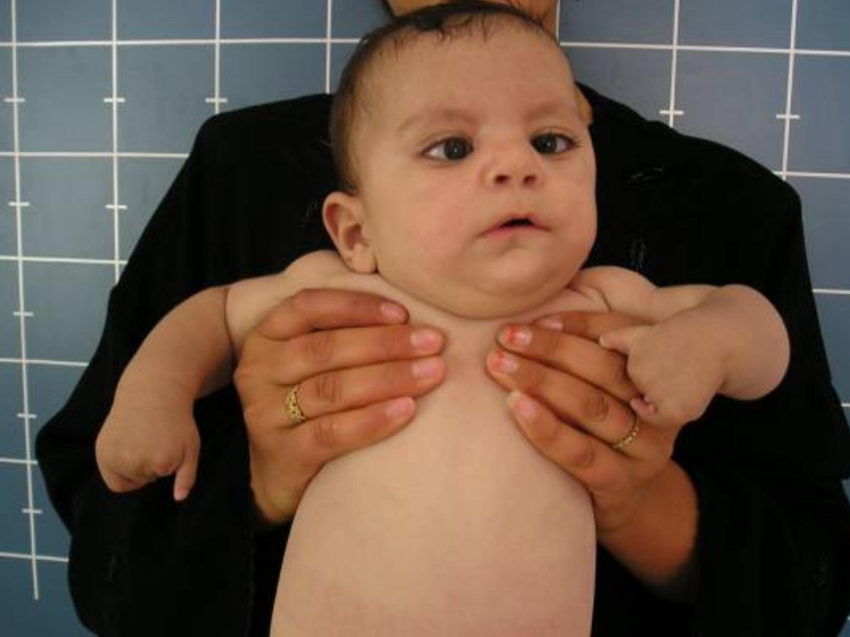 Infant with Möbius syndrome