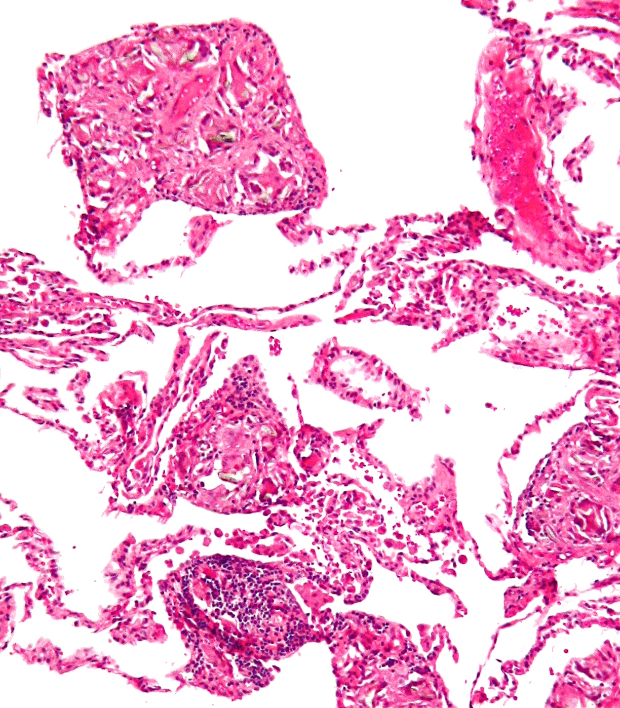 Micrograph of pulmonary talcosis