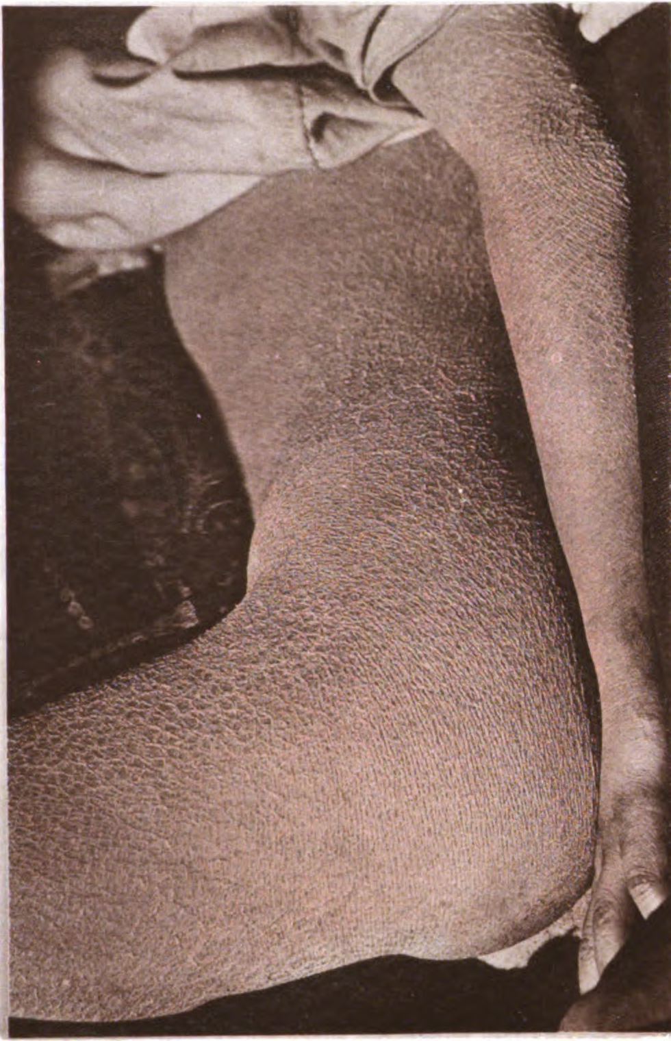 Ichthyosis