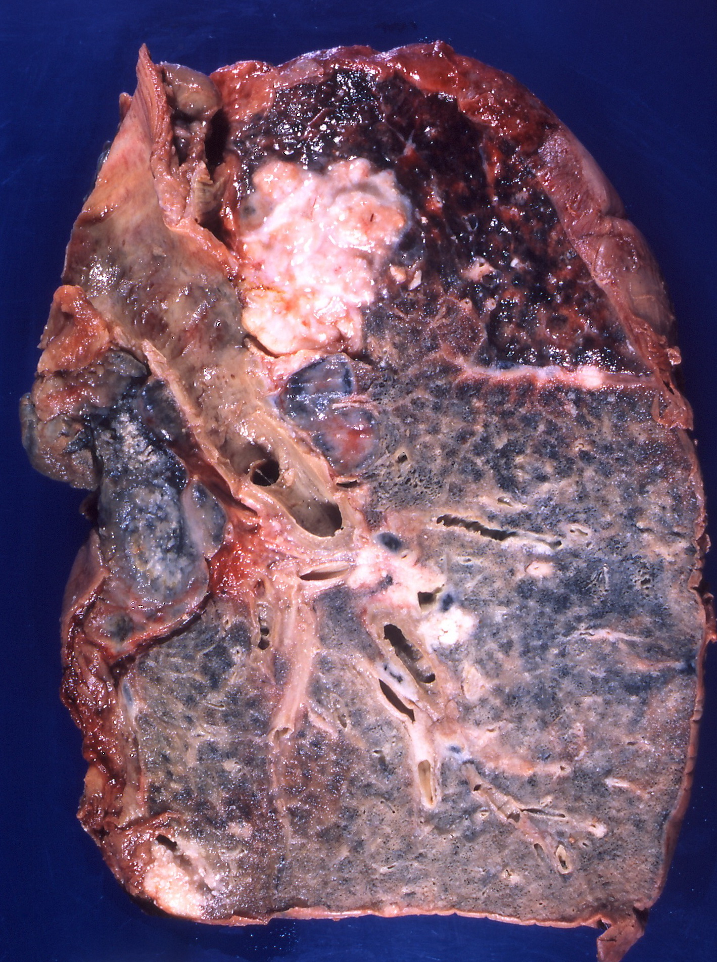 Squamous-cell carcinoma of the lung