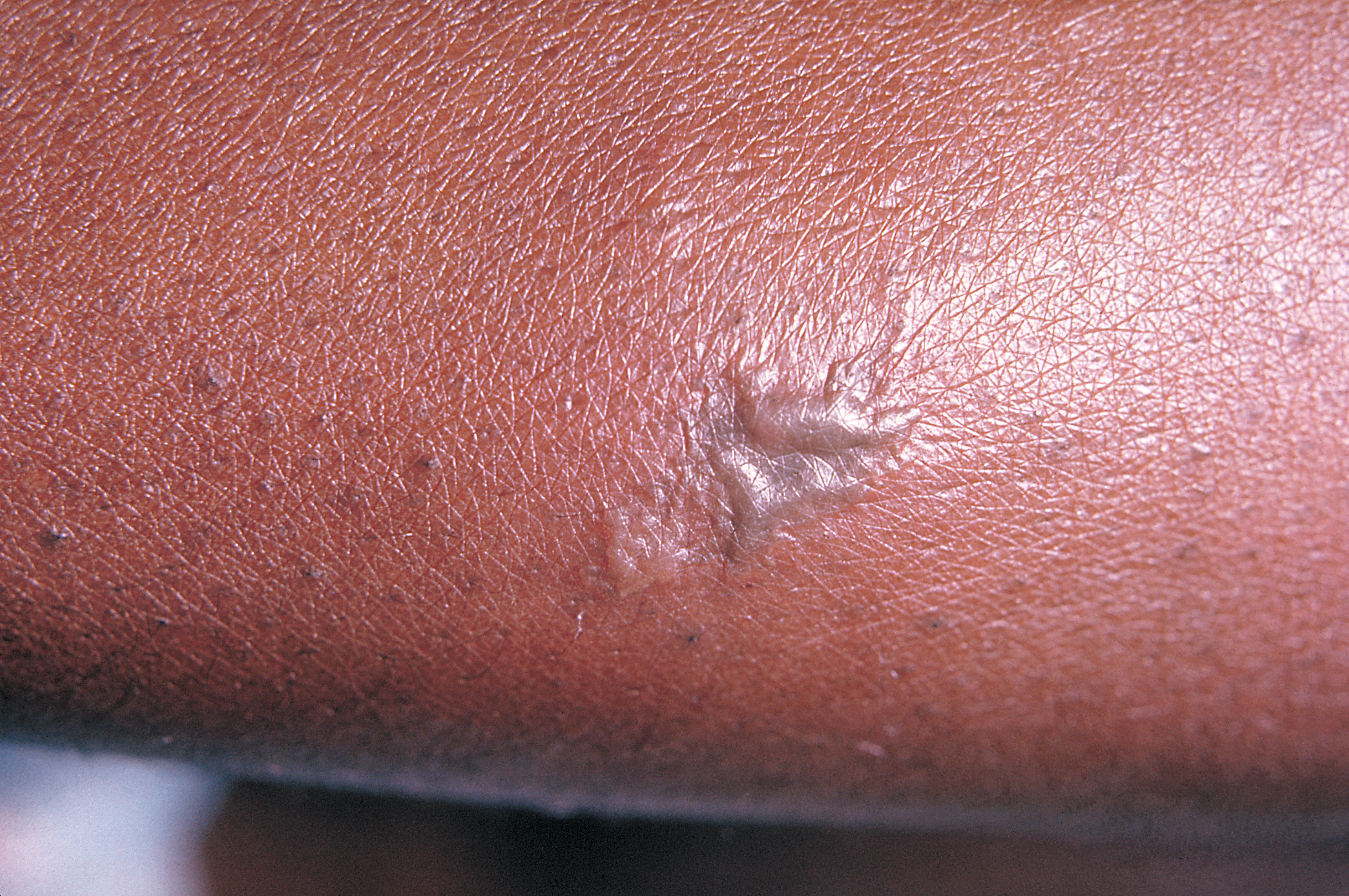 Gonococcal lesion on the skin