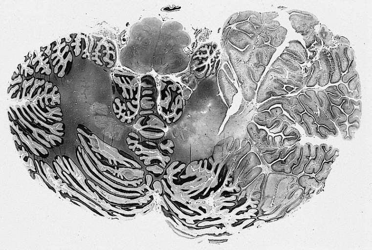 Micrograph of a ganglioglioma, a type of brain tumor