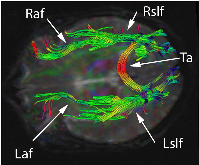 Brain tractographic image