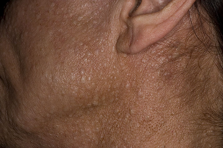 Image of Birt–Hogg–Dubé syndrome