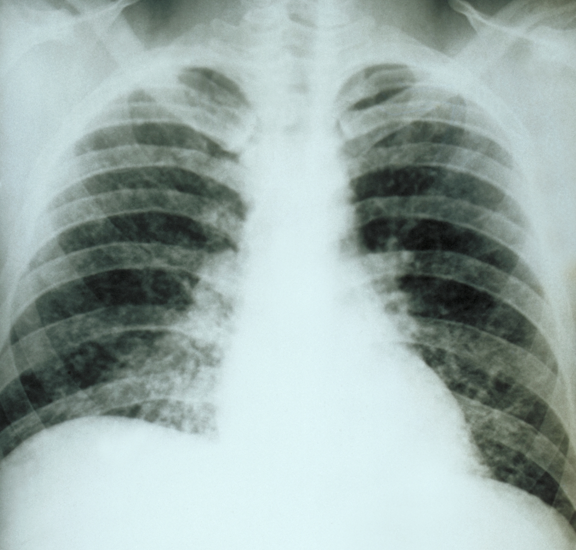 Chest X-ray showing acute pulmonary histoplasmosis