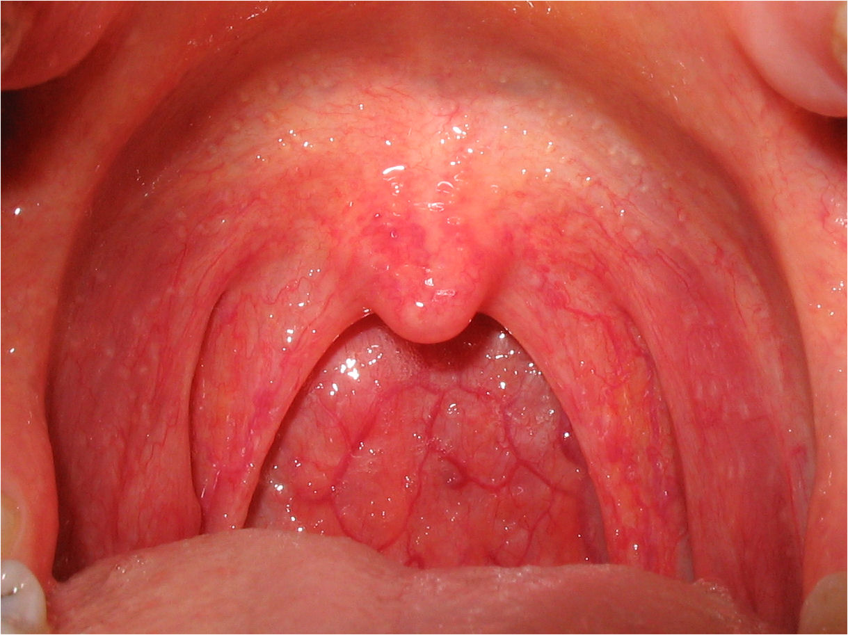 Throat inflammation