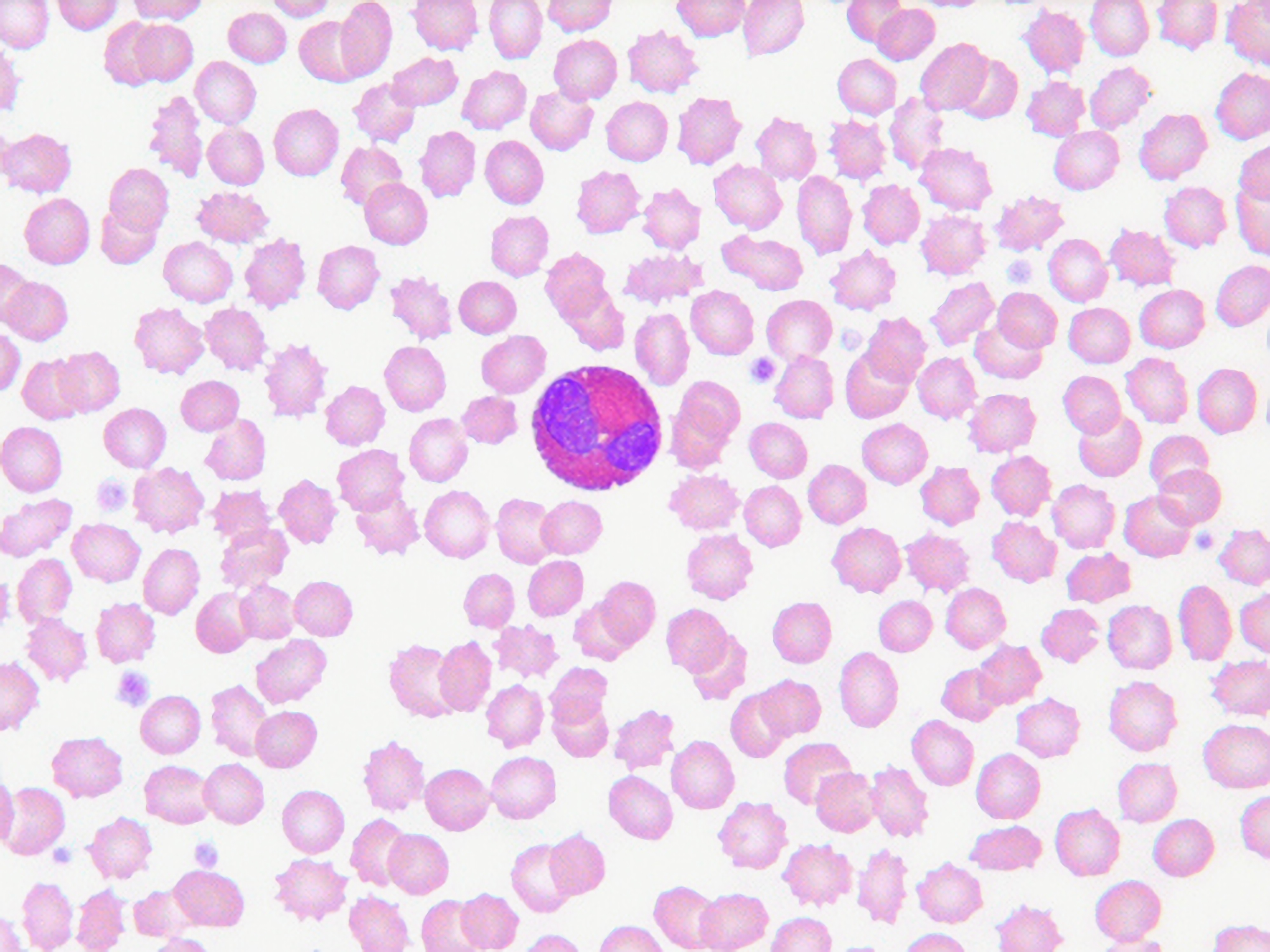 Eosinophils in peripheral blood